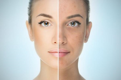 Пігментні плями: причини виникнення та лікування Пігментні плями: причини виникнення та лікування